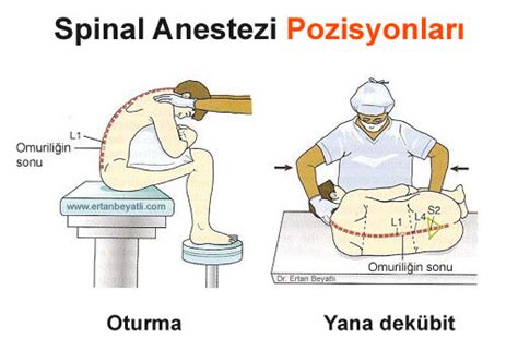 spinal anestezi sonrası yatış pozisyonu